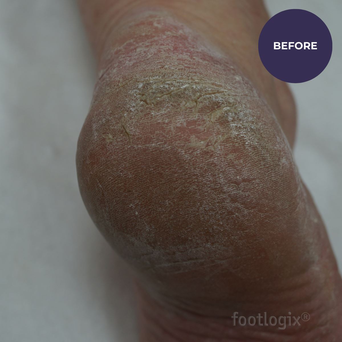 Footlogix Pedicure Callus Softener Professional Hard/Dry Skin 946ml