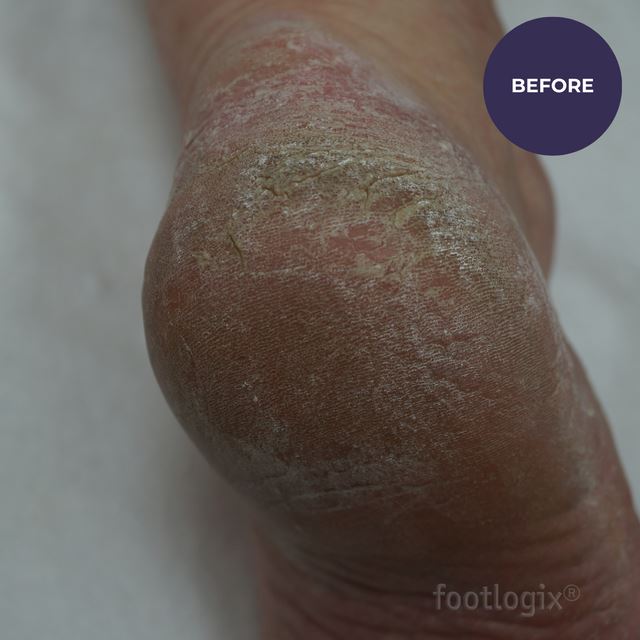 Footlogix Pedicure Callus Softener Professional Hard/Dry Skin 3.78 L