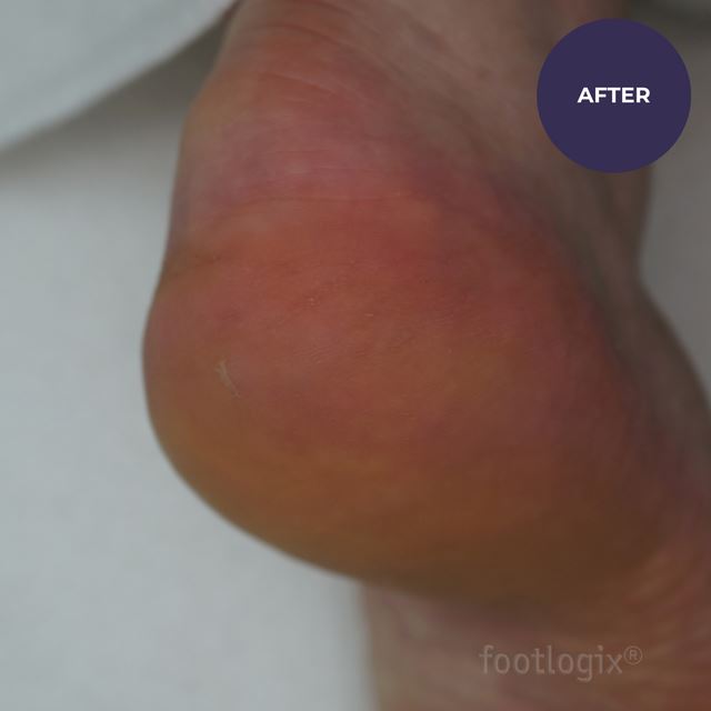 Footlogix Pedicure Callus Softener Professional Hard/Dry Skin 3.78 L